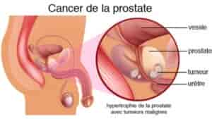 Cancer de la prostate : symptômes et causes