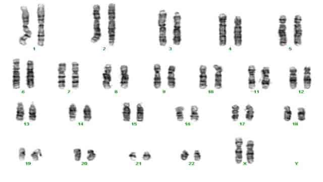 46,XX (G-banding)