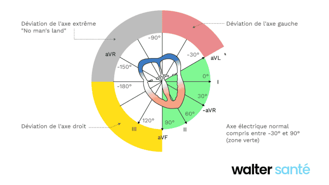 Vecteur global de l'activation ventriculaire dans le plan frontal