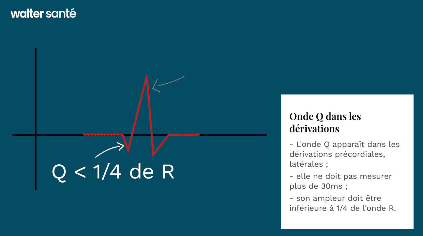 ECG : Onde Q dans les dérivations