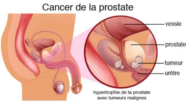 cancer prostate symptome cancer de la prostate traitement docteur vincent elalouf centre urologie paris sud urologue paris 16