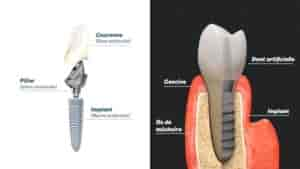 Quelle marque d'implant dentaire choisir ?