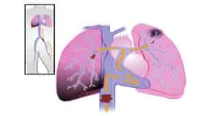 Embolie pulmonaire